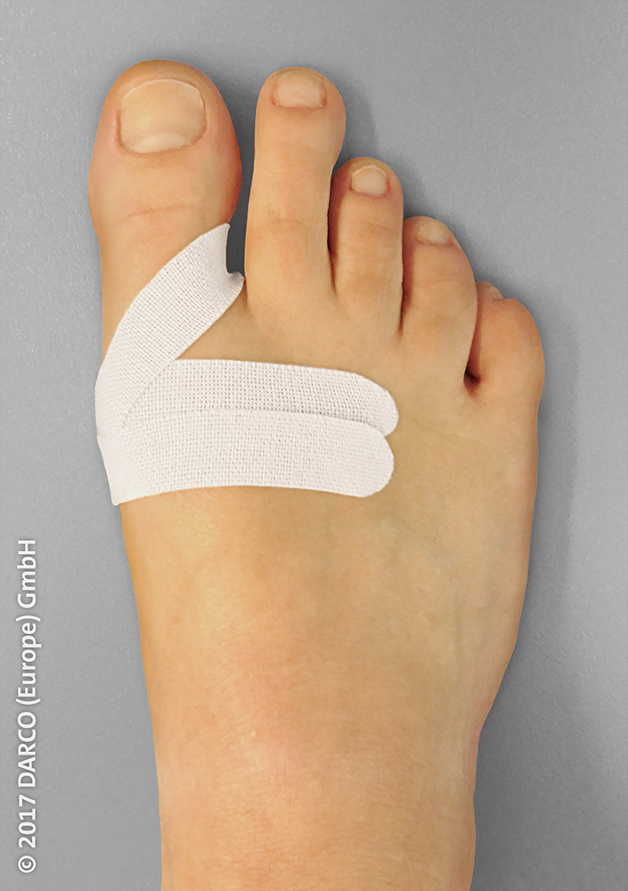 Aplikacja MECRON RDS po osteotomii Chevron